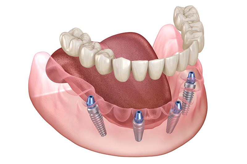 All on 4 Dental Implants Beckley