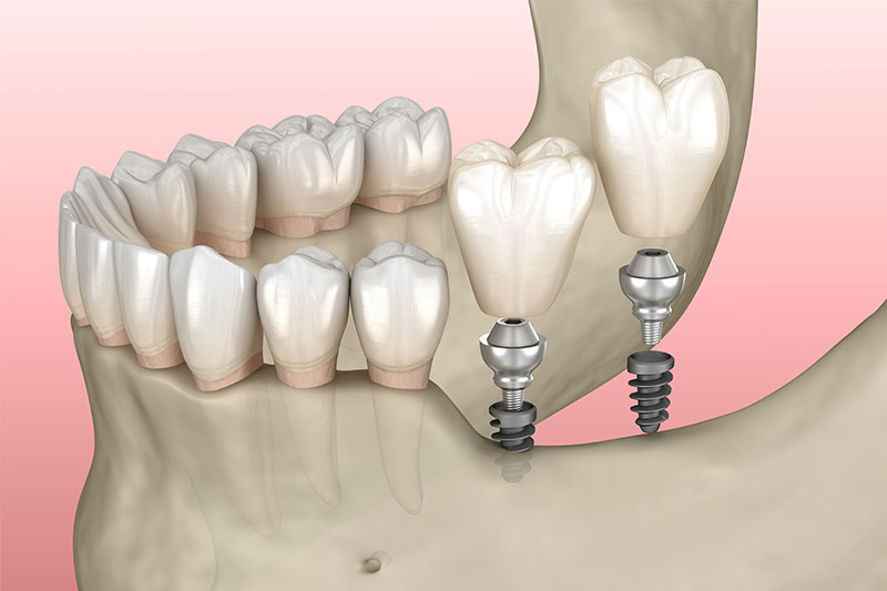 Mini Dental Implants Beckley
