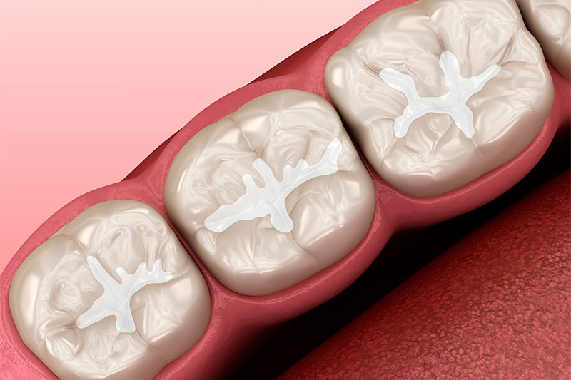 Dental Sealants Beckley