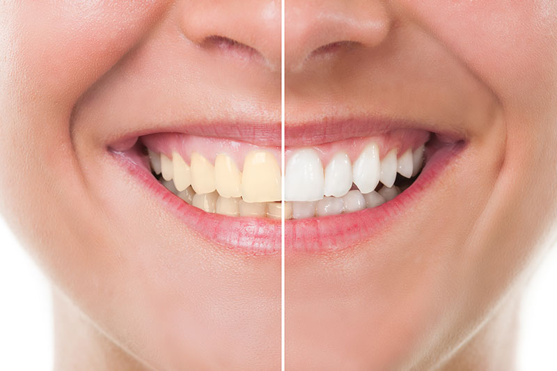 Teeth Whitening in Beckley