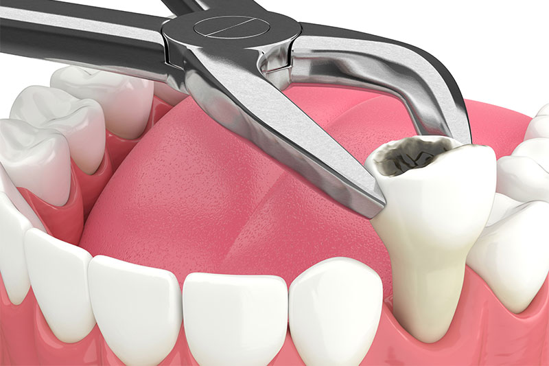Tooth Extractions Beckley